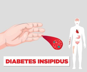 diabetes-insipidus